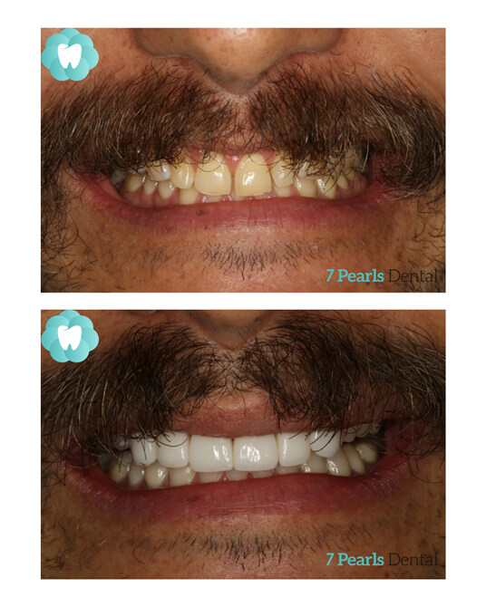 before-after-crowns-2