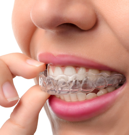 closeup-of-womans-mouth-with-clear-aligners