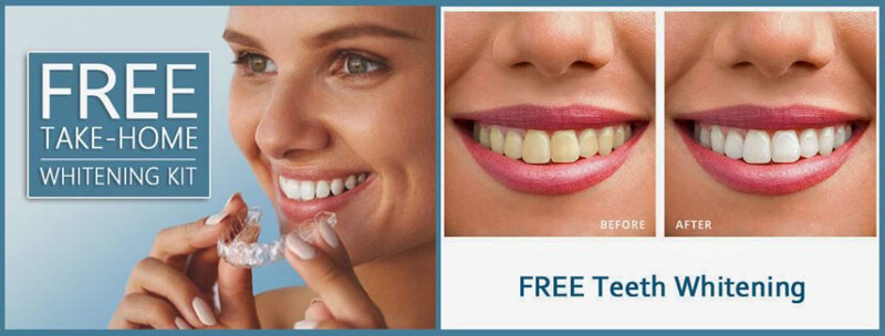 Free Teeth Whitening offer
