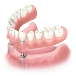 Implant supported dentures