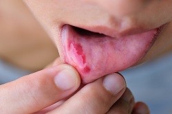 Person with oral cancer on their tongue