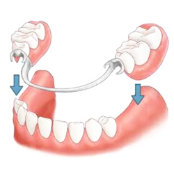 partial denture