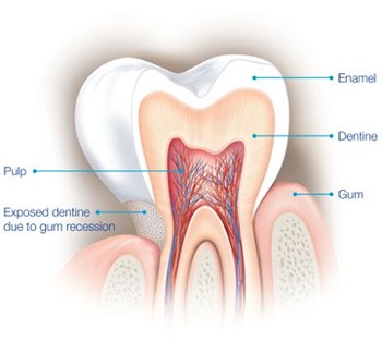 diagram of sensitive teeth