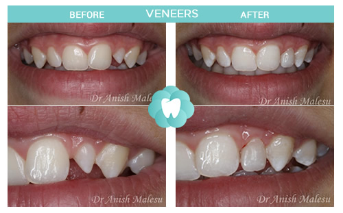 crooked teeth before and after veneers