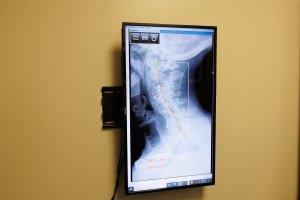 Omaha Chiropractor helping Migraine Headaches