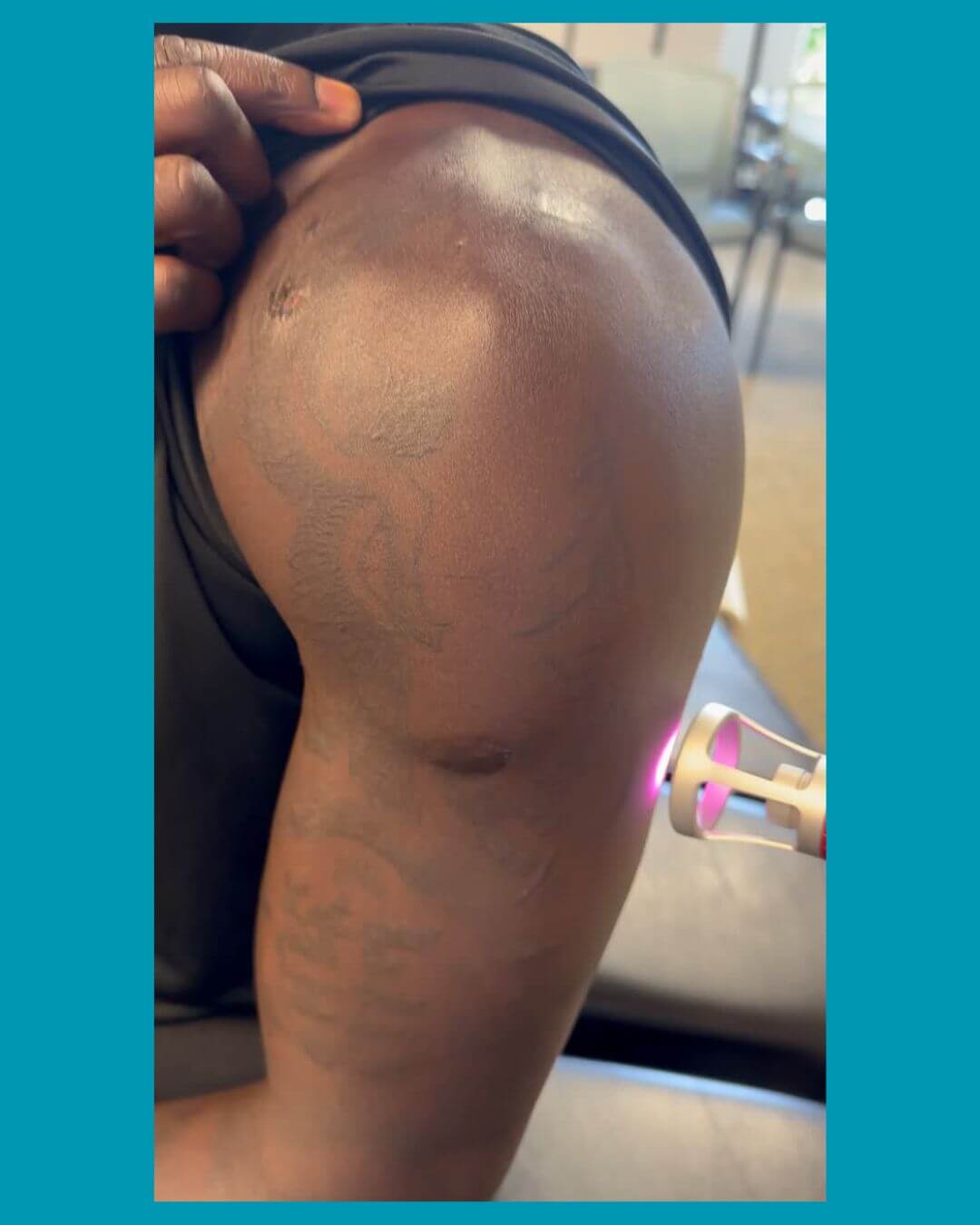 cold laser therapy on shoulder