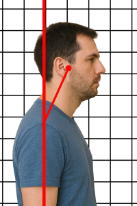 Forward Head Posture causing headaches.