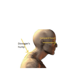 Hunchback Posture fix at Green Chiropractic