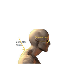 Hunchback Posture fix at Green Chiropractic