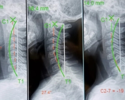 X-Rays comparison