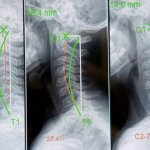 Chiropractic Biophysics. Spinal Remodeling for Chronic Neck, Shoulder, and Headache Pain