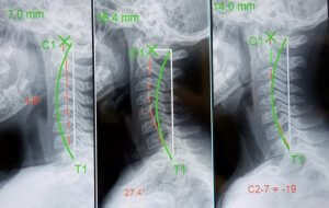 Chiropractic Biophysics. Spinal Remodeling for Chronic Neck, Shoulder, and Headache Pain