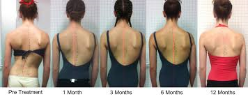 Scoliosis Remodeling