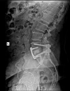 LAT Lumbar - January