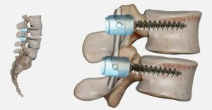 Spinal Fusion