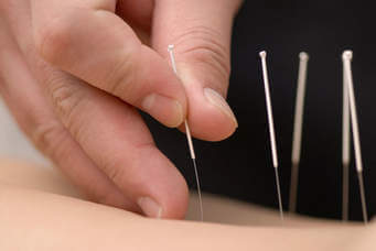 Dry needling