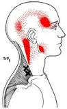 upper trapezius