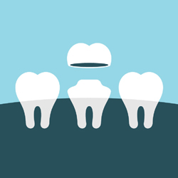 Illustration of dental crown