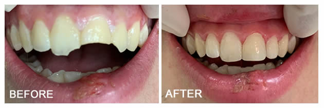 chipped teeth before after