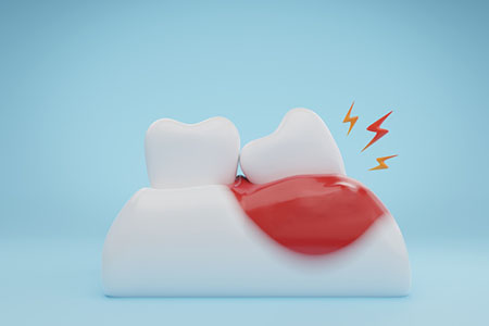 Gums and teeth disease wisdom tooth infection on blue background.