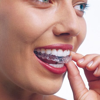 Invisalign clear braces