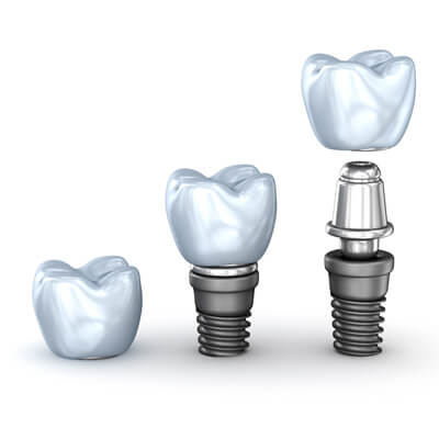 Illustration of dental implant