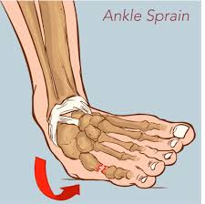 https://www.joionline.net/trending/content/sprained-ankle