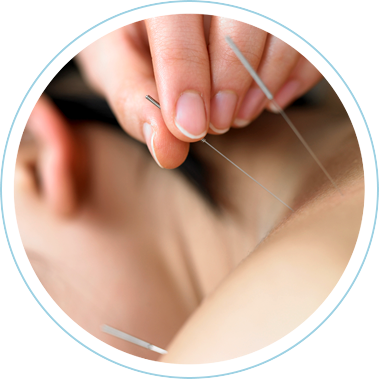 Acupuncture needles