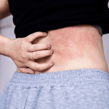 Mast Cell Activation Syndrome