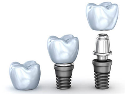 illustration of dental implant