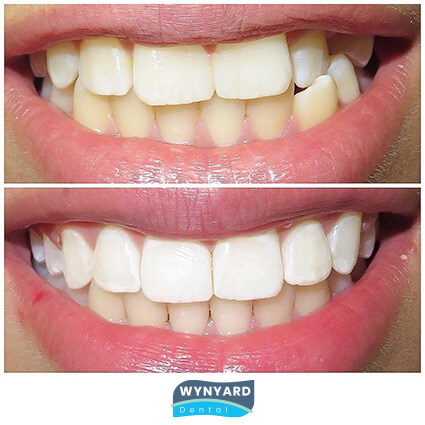 orthodontics before and after 5