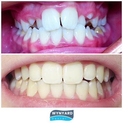 orthodontics before and after 4