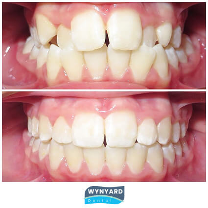 orthodontics before and after 6