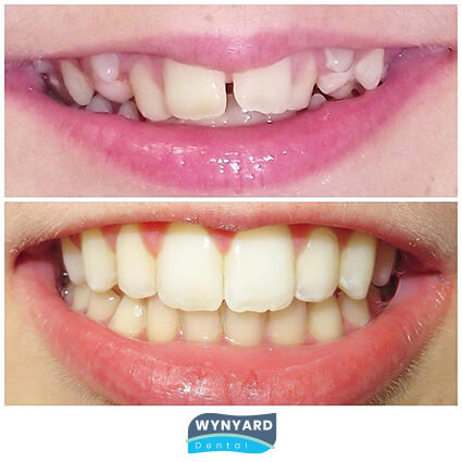 orthodontics before and after 3