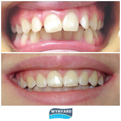 orthodontics before and after 2