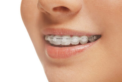 person with ceramic braces