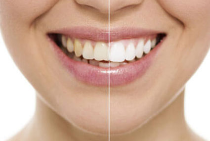 teeth whitening before and after