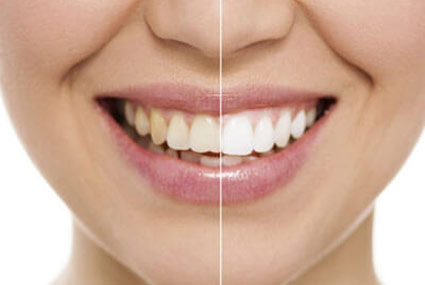 teeth whitening before and after