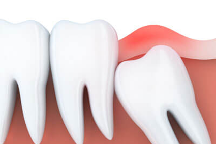 wisdom tooth illustration