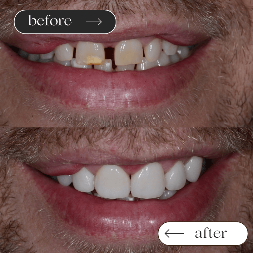 veneers case 1