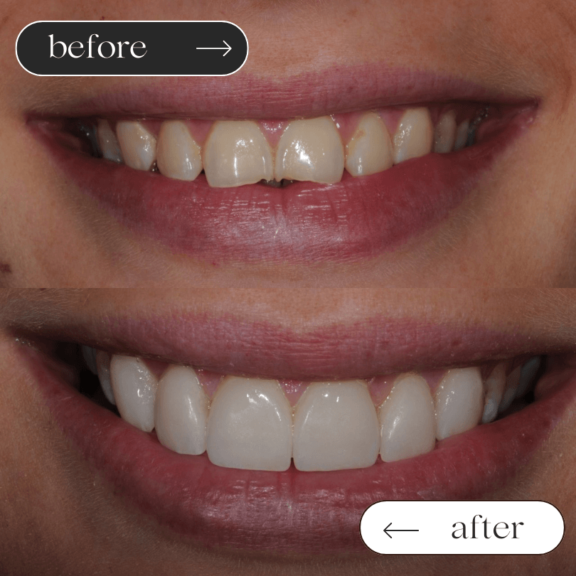 veneers case 2