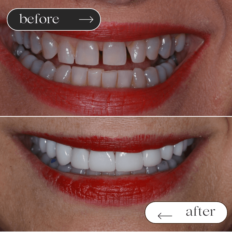 veneers case 3