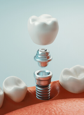 banner-implants