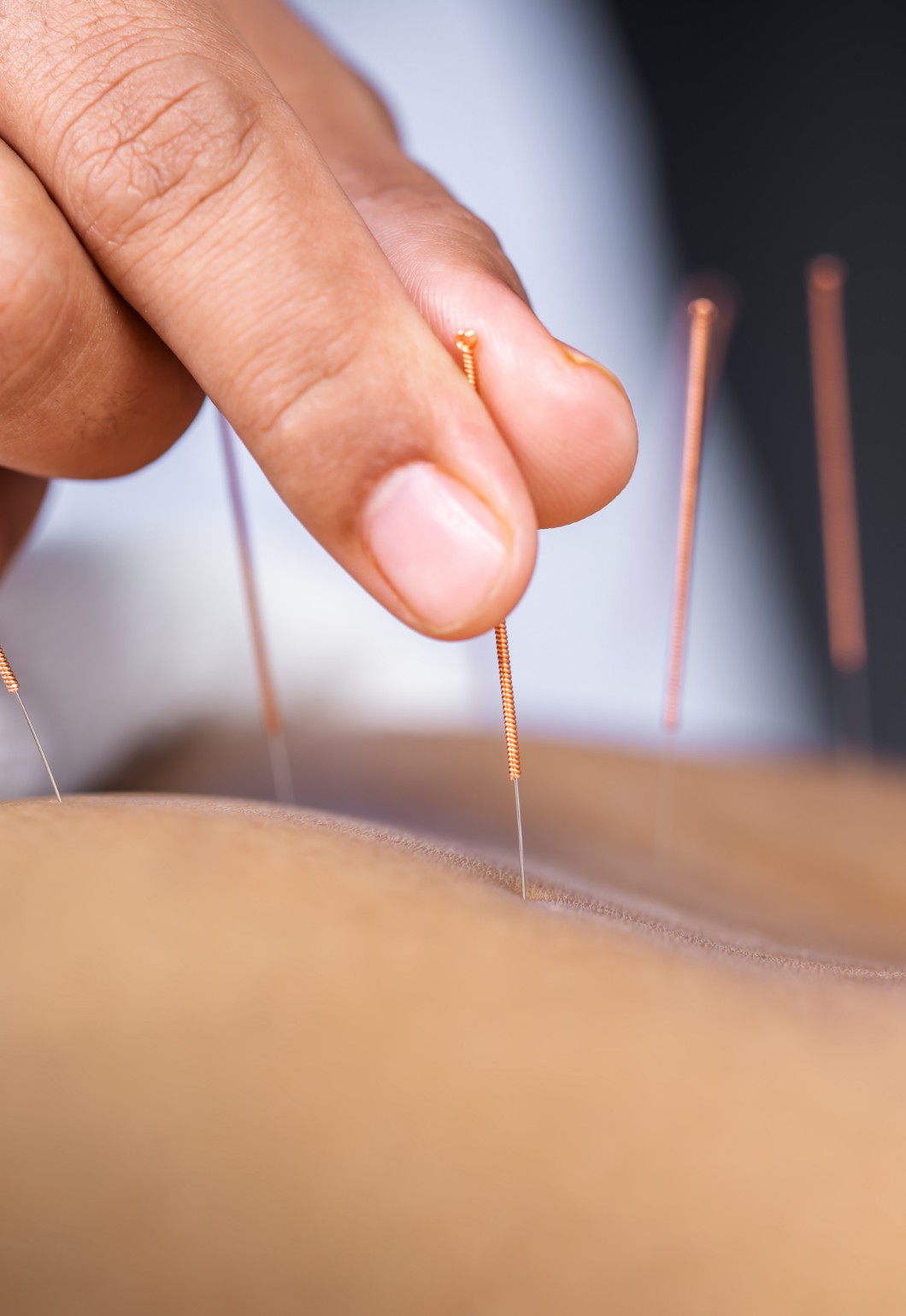 acupuncture needles