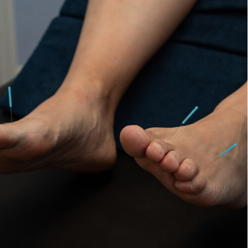 Acupuncture needles used on feet