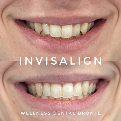 Invisalign-before-and-after