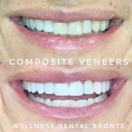 composite veneers before and after