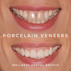 veneers before and after 1