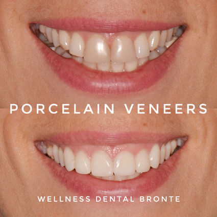 veneers before and after 1
