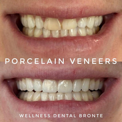veneers gallery 3